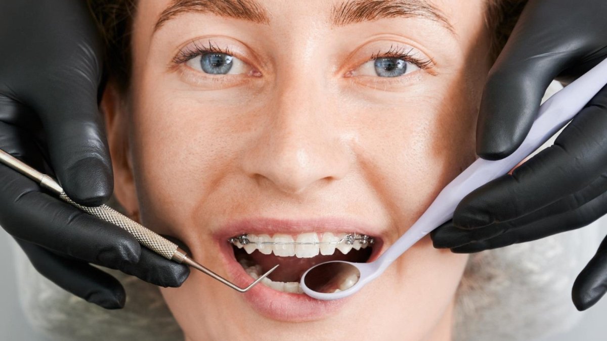 Sourire parfait : les bienfaits esthétiques de l’orthodontie à Montréal ! - Santé gourmet Image